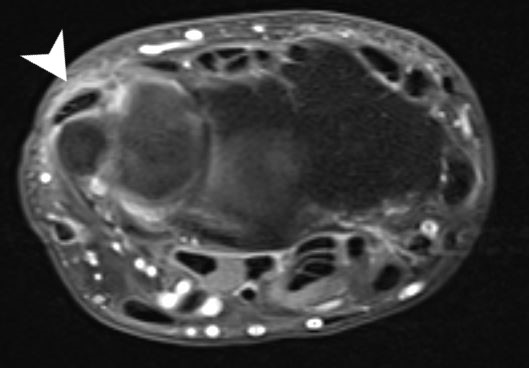 <p>Extensor Carpi Ulnaris Tenosynovitis on Magnetic Resonance Imaging