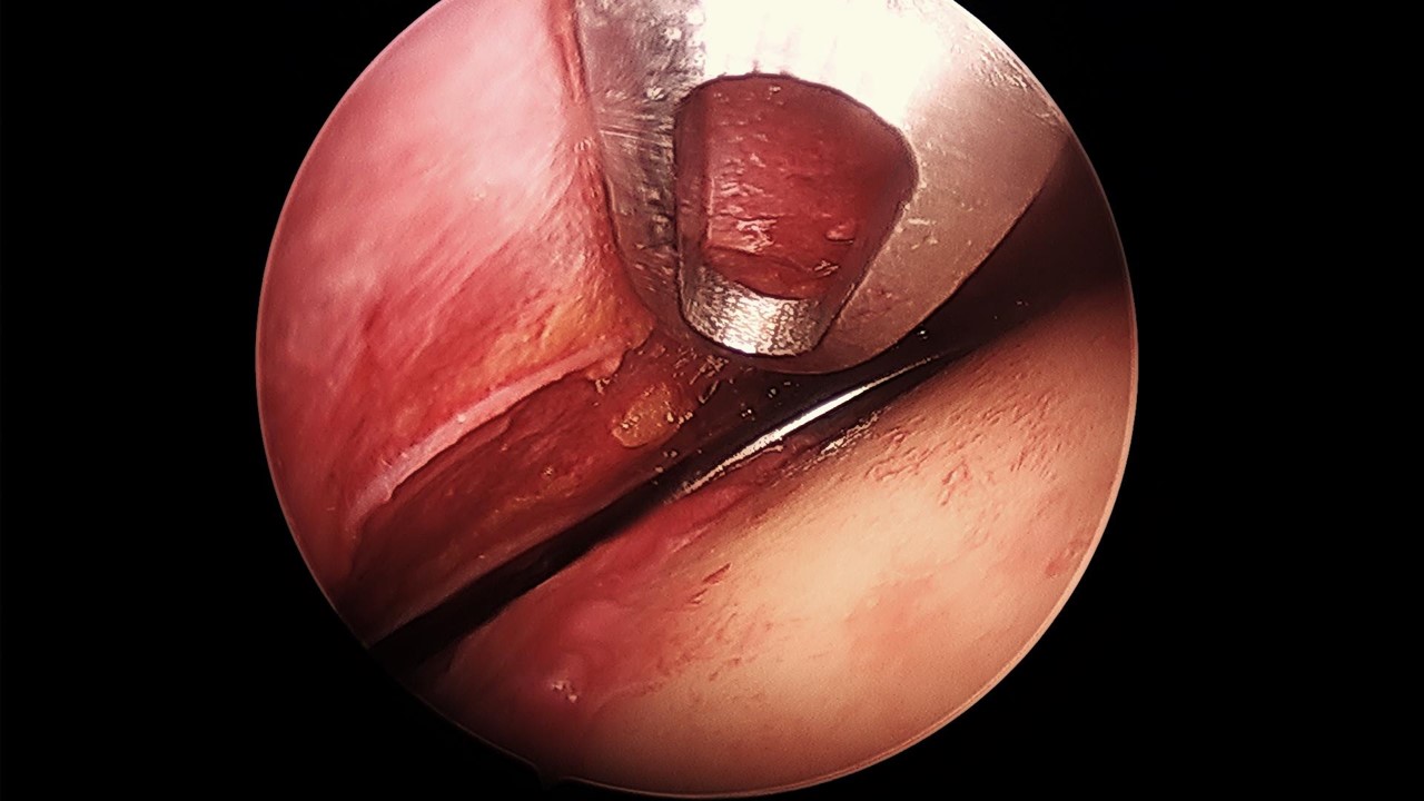 <p>Frontal Branch of the Facial Nerve on Endoscopy