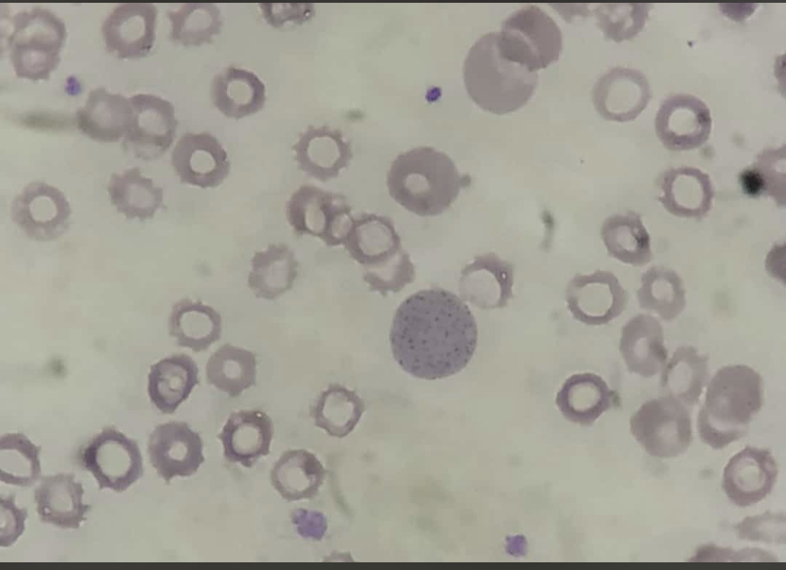 <p>Basophilic Stippling
