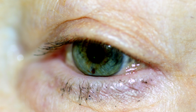 <p>Lateral Conjunctivochalasis