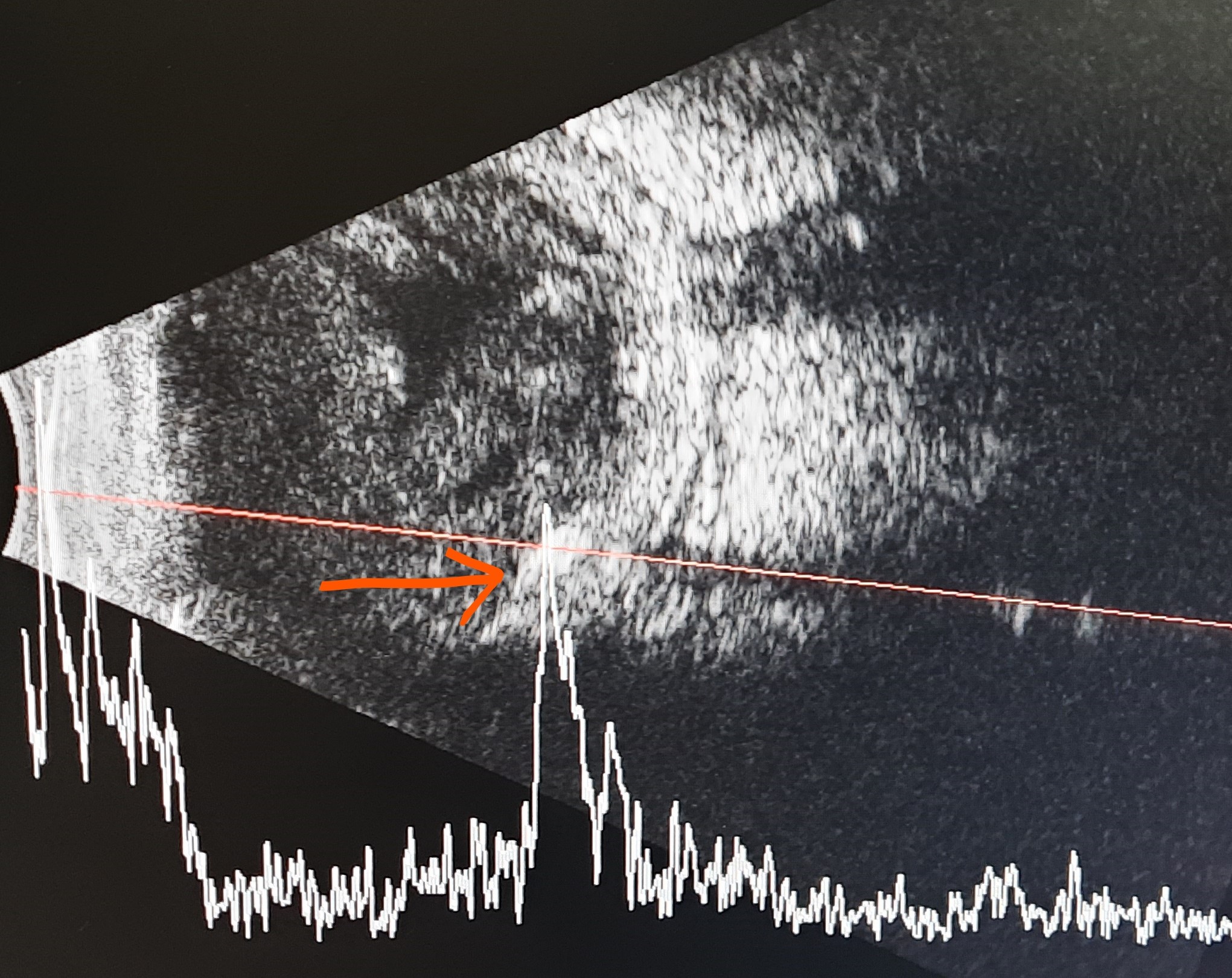 <p>Metallic Foreign Body Over Retina