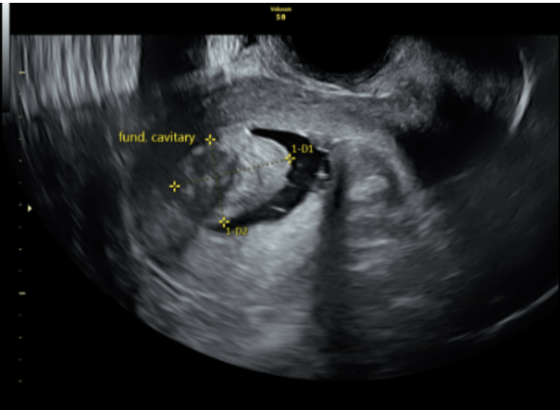<p>Saline Infusion Sonohysterogram of Intracavitary Fibroid