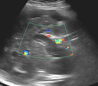 <p>Ultrasound of Portal Vein Thrombosis. Ultrasound imaging demonstrating thrombosis of the portal vein.</p>