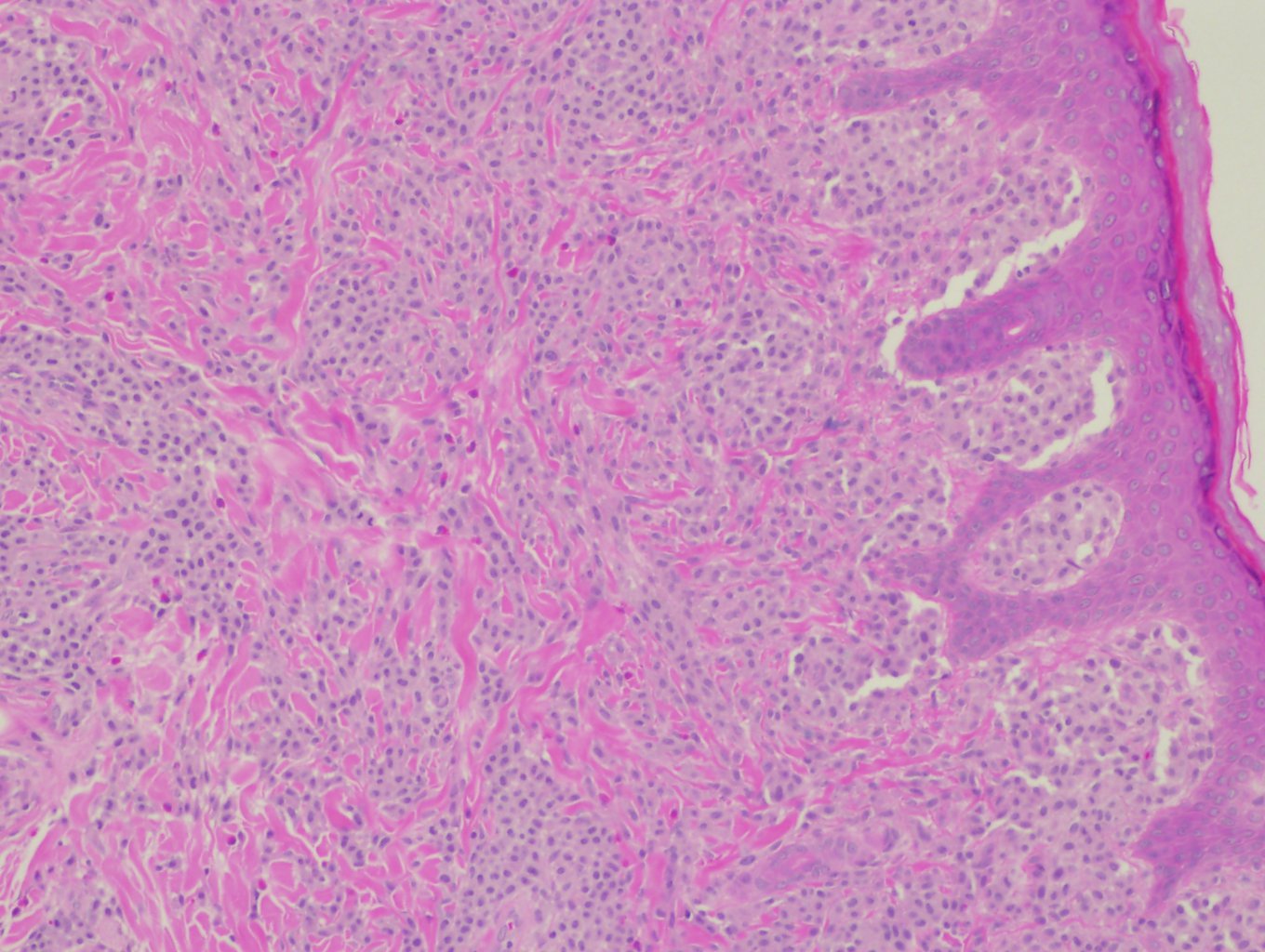 <p>Solitary Mastocytoma of Skin