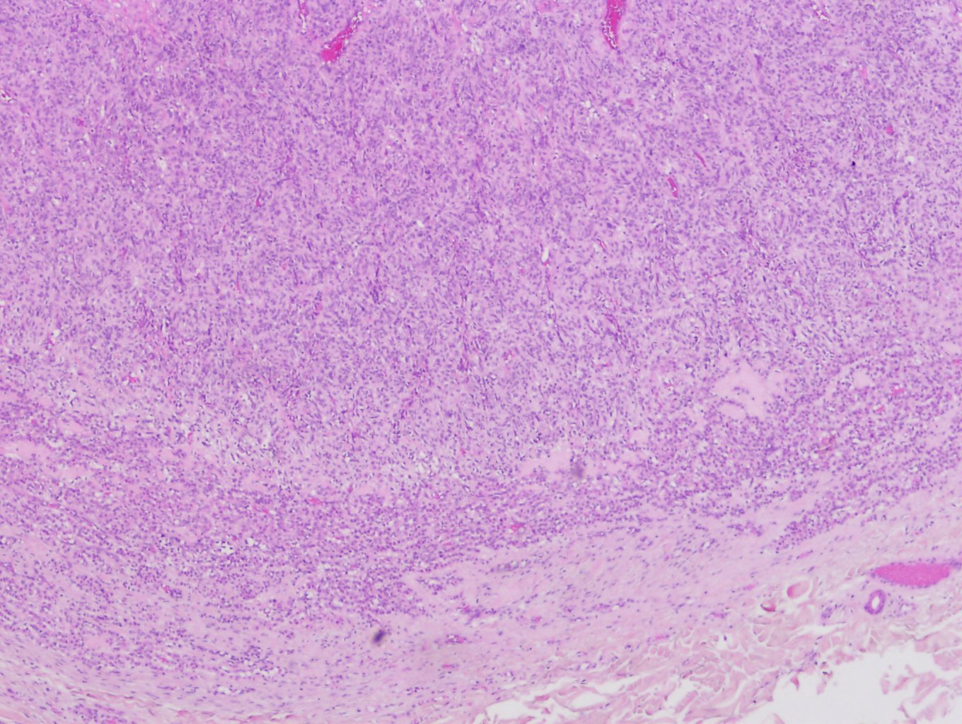 Glomangioma