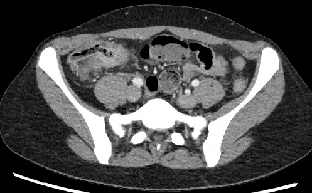 <p>Crohn Disease on Computed Tomography