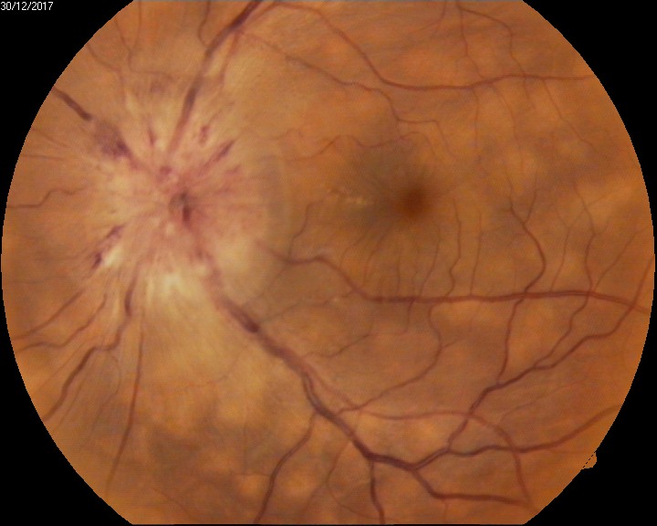 <p>Acute Fundus Findings in Vogt-Koyanagi-Harada Syndrome