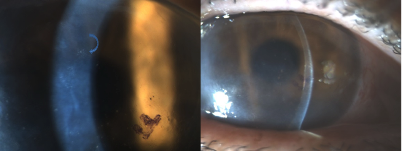 <p>Cytomegalovirus Endotheliitis on&nbsp;Slit-Lamp Examination