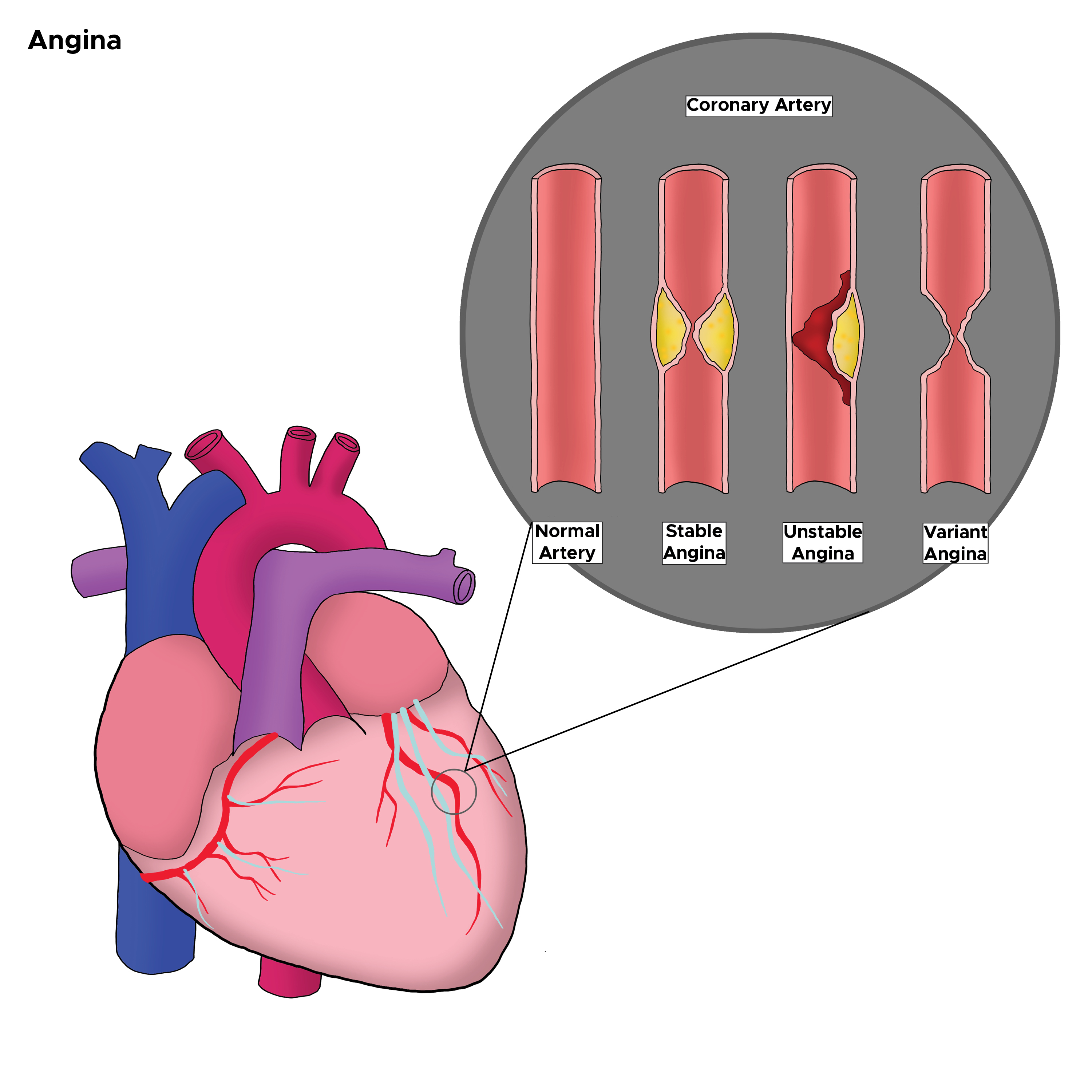 <p>Coronary Artery&nbsp;Changes and Corresponding Types of Angina
