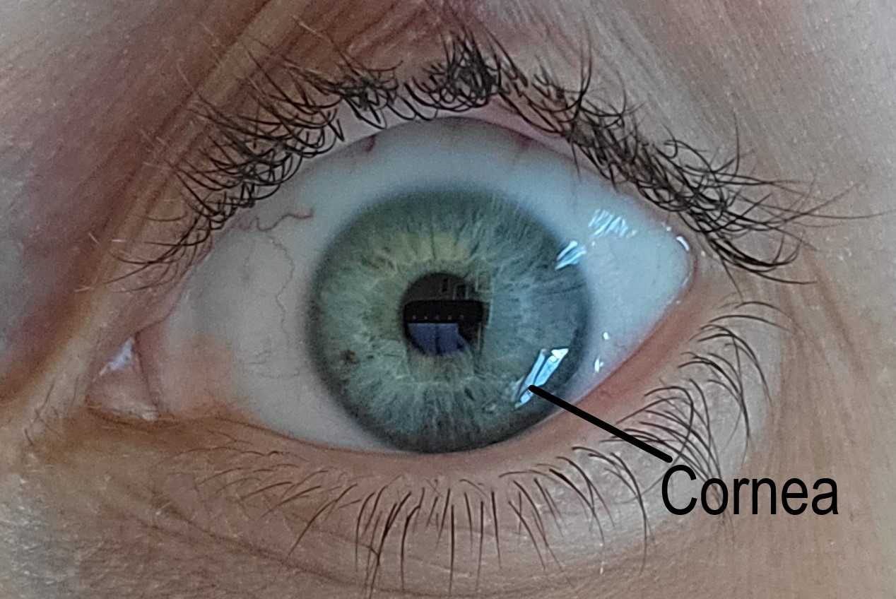 <p>Normal Cornea. A normal cornea is transparent, avascular, and acts as a barrier to infection.</p>