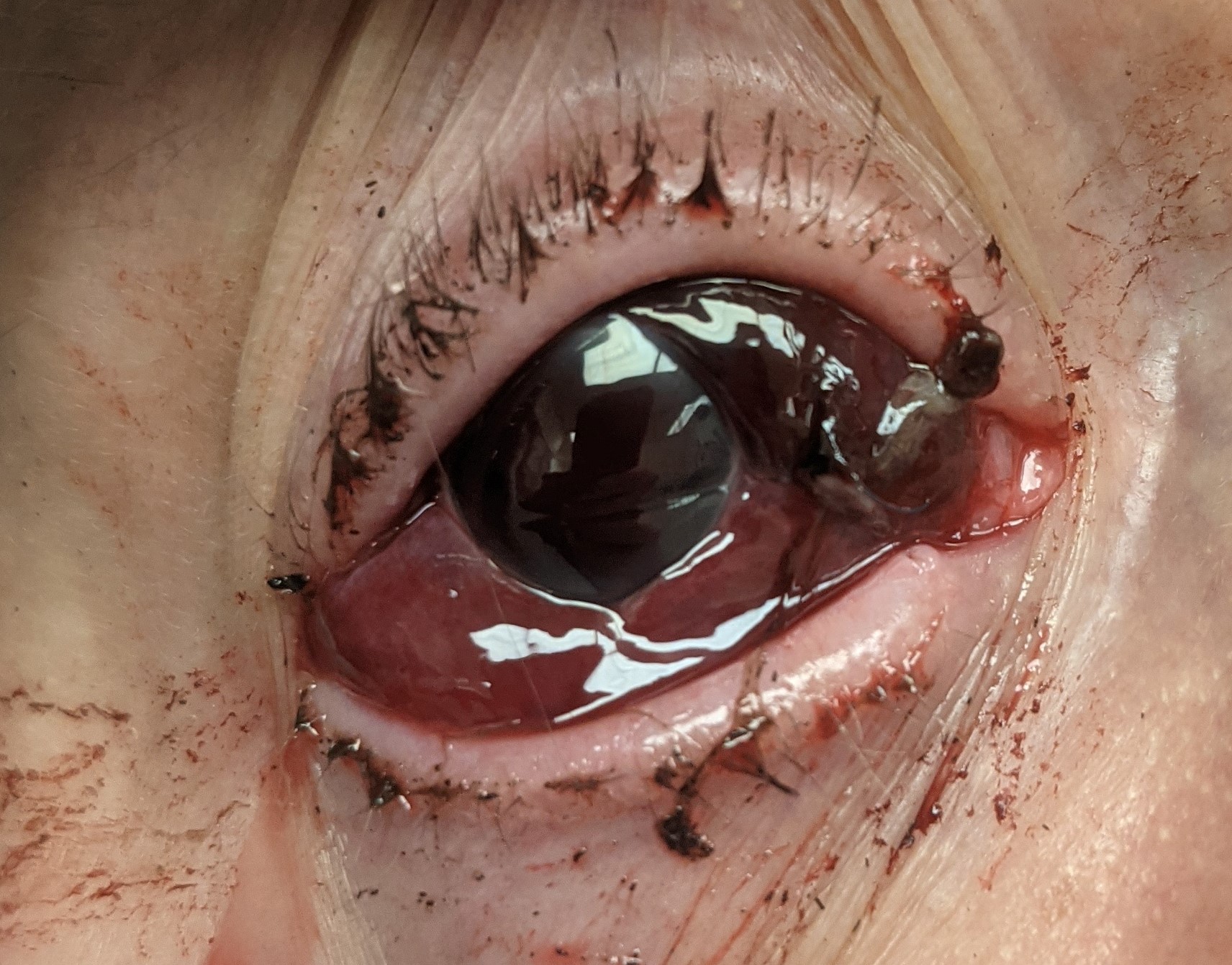 <p>Corneoscleral Laceration