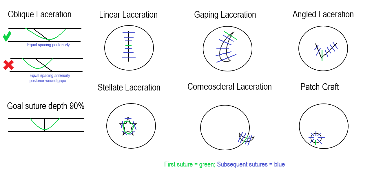 <p>Corneal Laceration Suture Techniques. Image describing various corneal laceration techniques.</p>