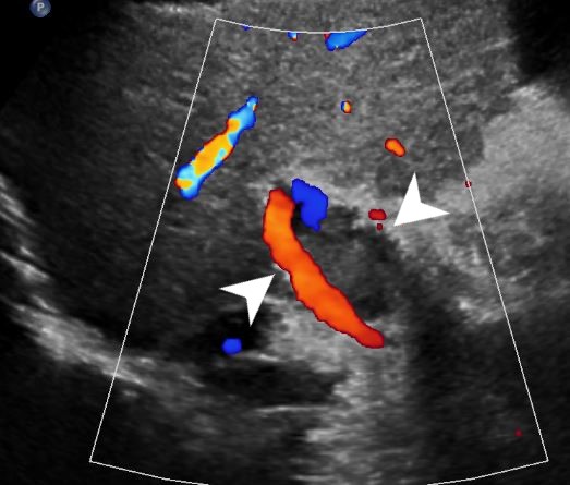<p>Portal Vein Thrombosis