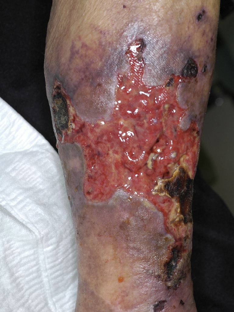 <p>Calciphylaxis.</p>