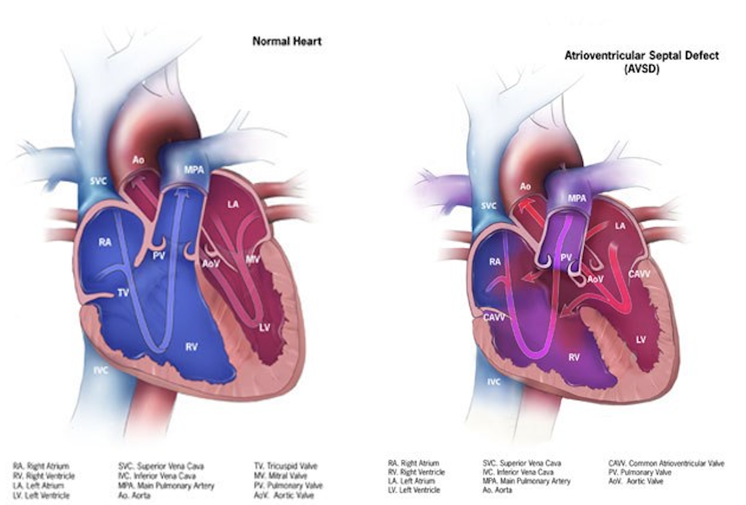 <p>Anatomy of a Heart With Atrioventricular Septal Defects