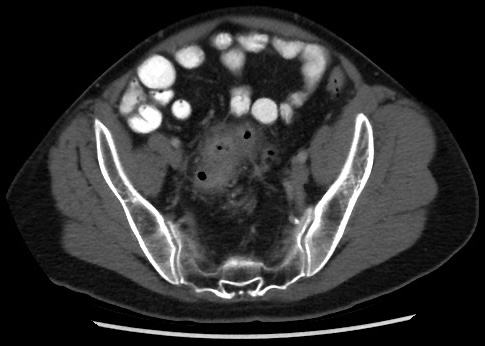 <p>Acute Uncomplicated Diverticulitis