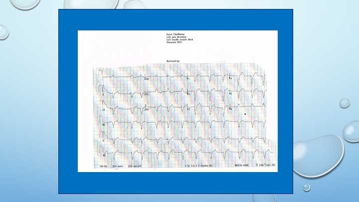 <p>Electrocardiogram, Atrial Fibrillation.</p>