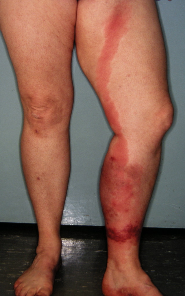 <p>Cellulitis.&nbsp;This image shows the characteristic reddening of the skin seen in cellulitis.&nbsp;</p>