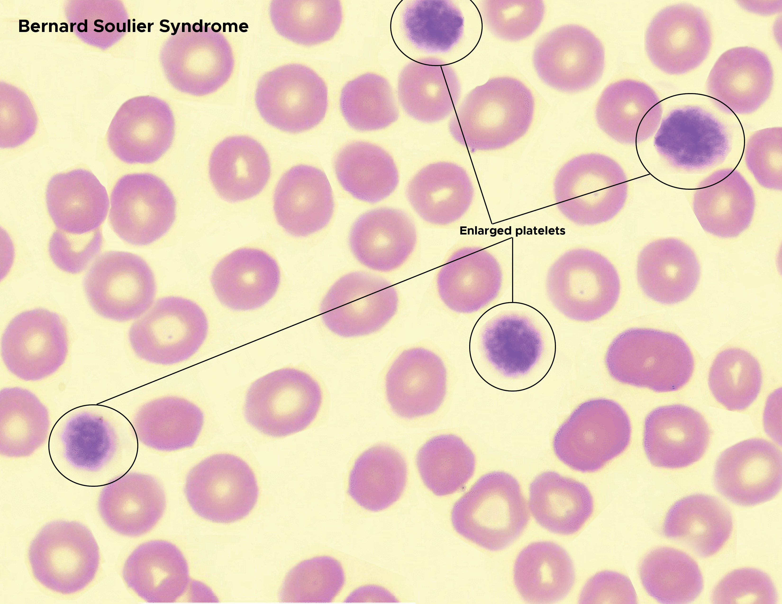 <p>Bernard Soulier Syndrome