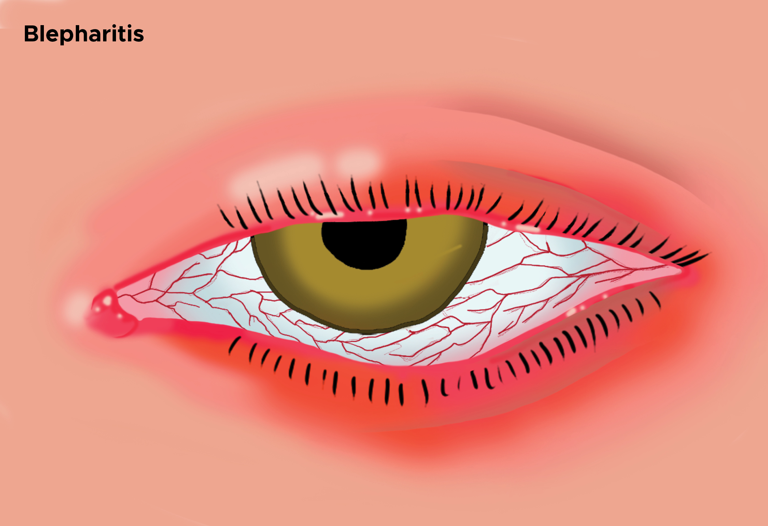 <p>Illustration of Blepharitis