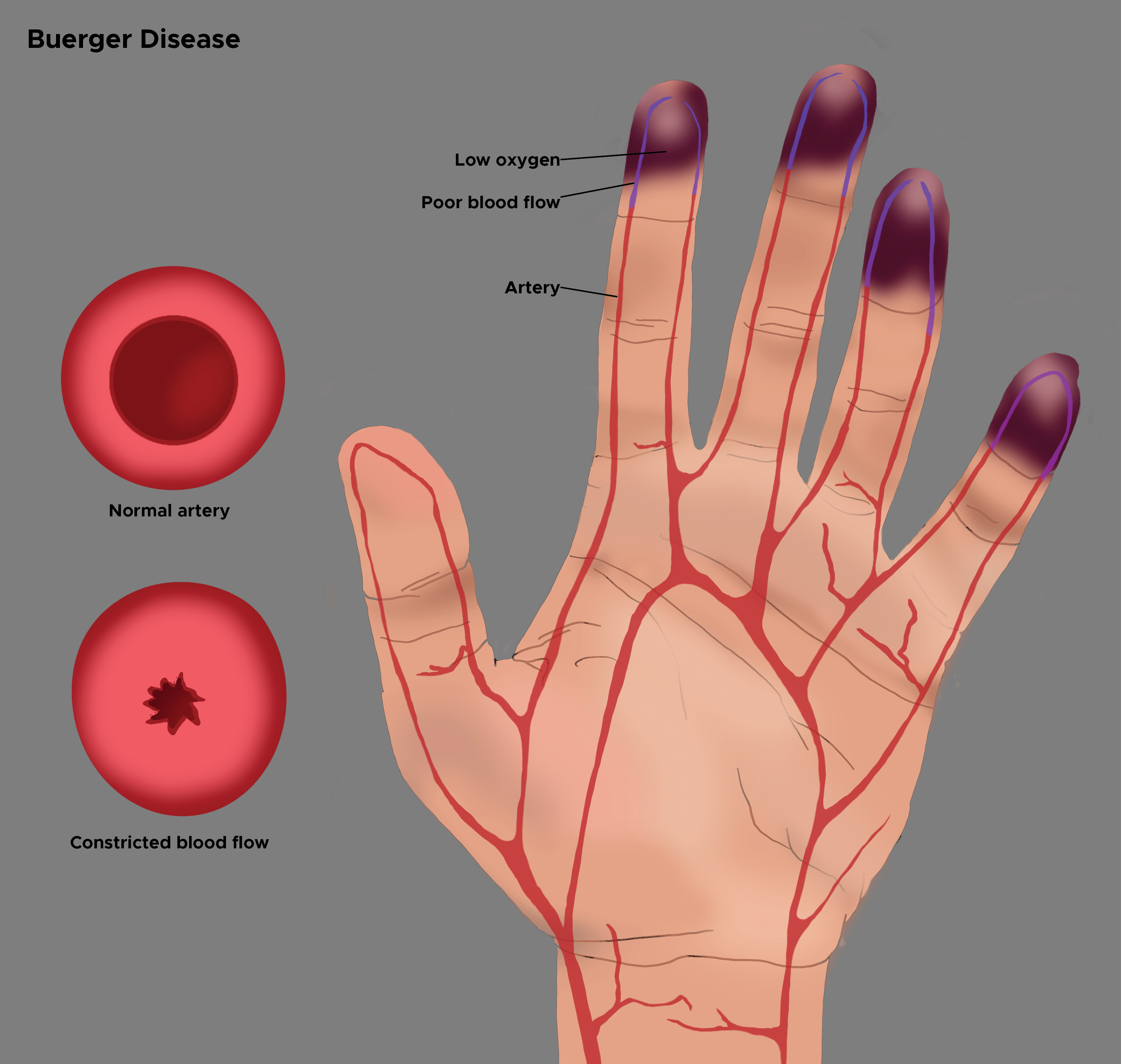 <p>Illustration of Buerger Disease