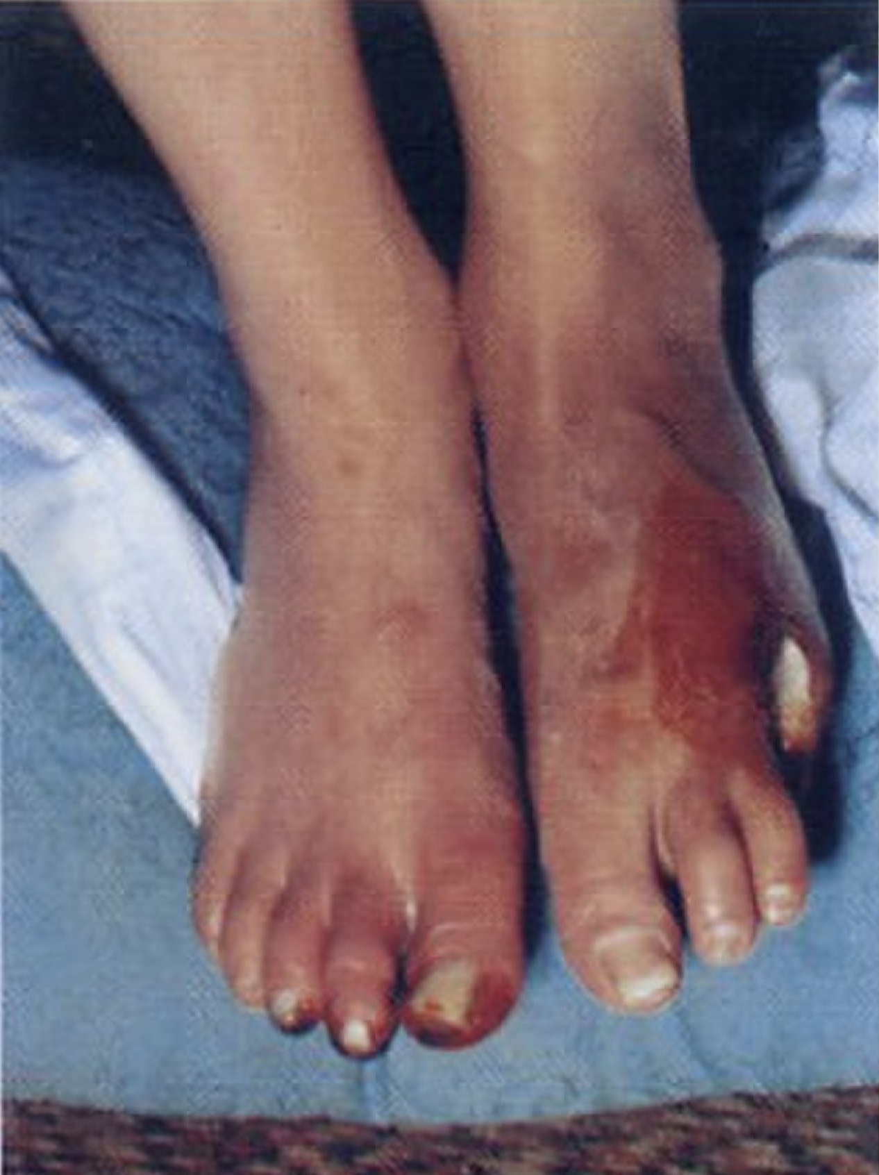 <p>Digital Ischemia and Ulceration of the Foot