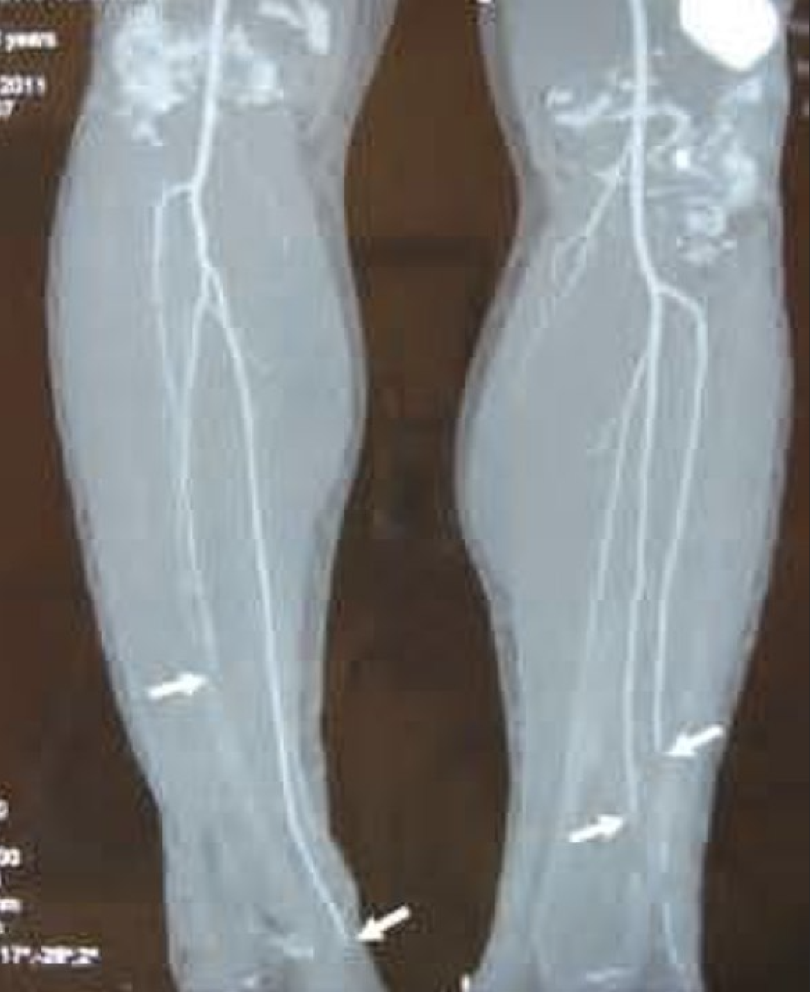 <p>CT Angiography in Buerger Disease