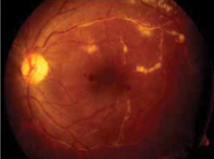 <p>Retinal Vasculitis with Candle-Wax Dripping Exudates