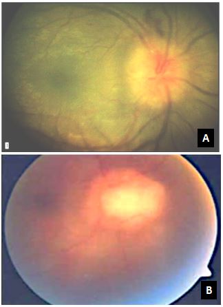 <p>Optic Disc Edema and Chorioretinal Granuloma in Granulomatous Uveitis