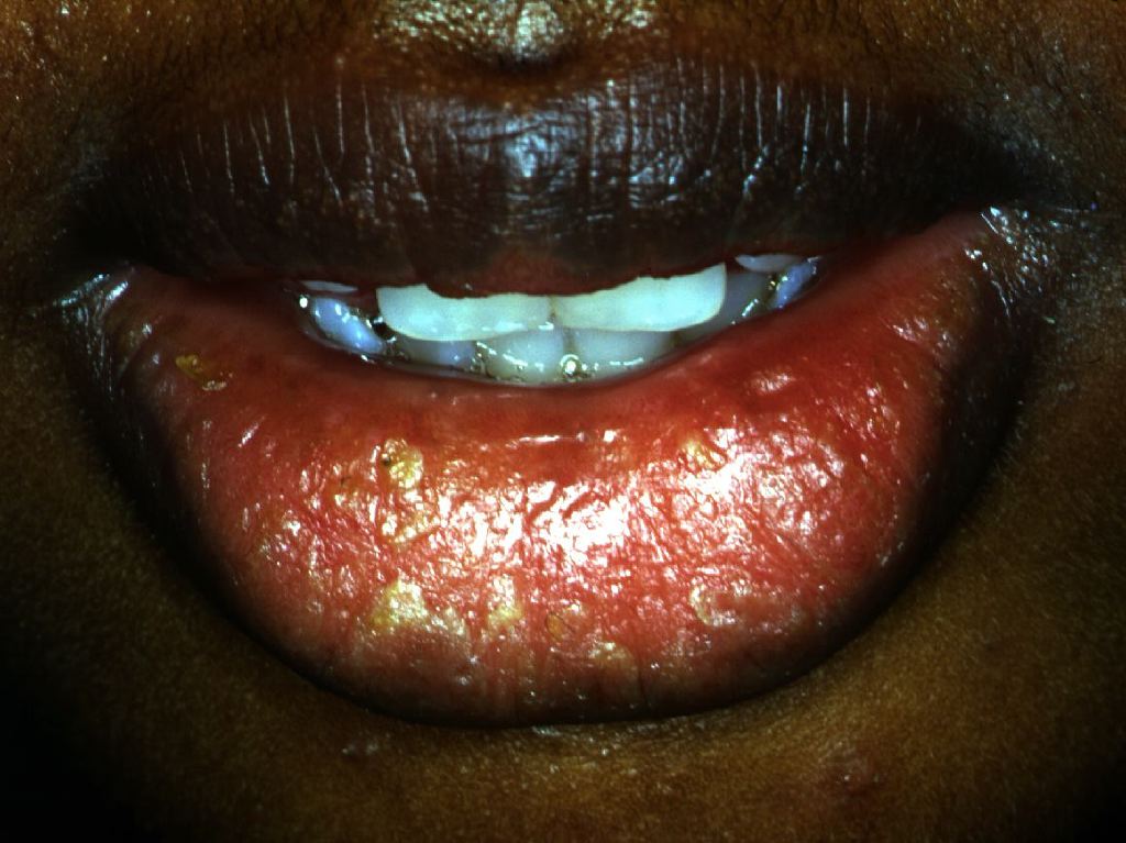 <p>Cheilitis Glandularis.</p>