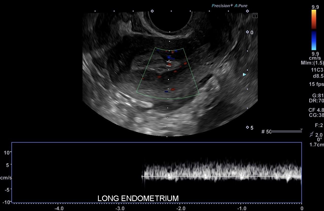 <p>Endometrial Polyp