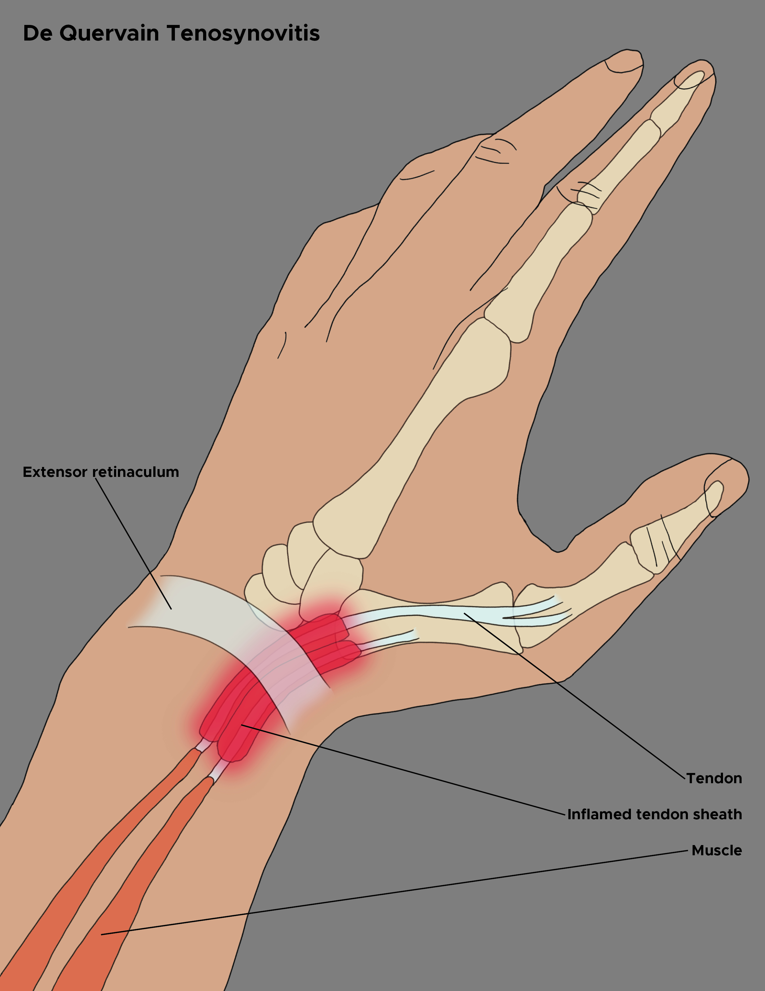 <p>De Quervain Tenosynovitis Anatomy