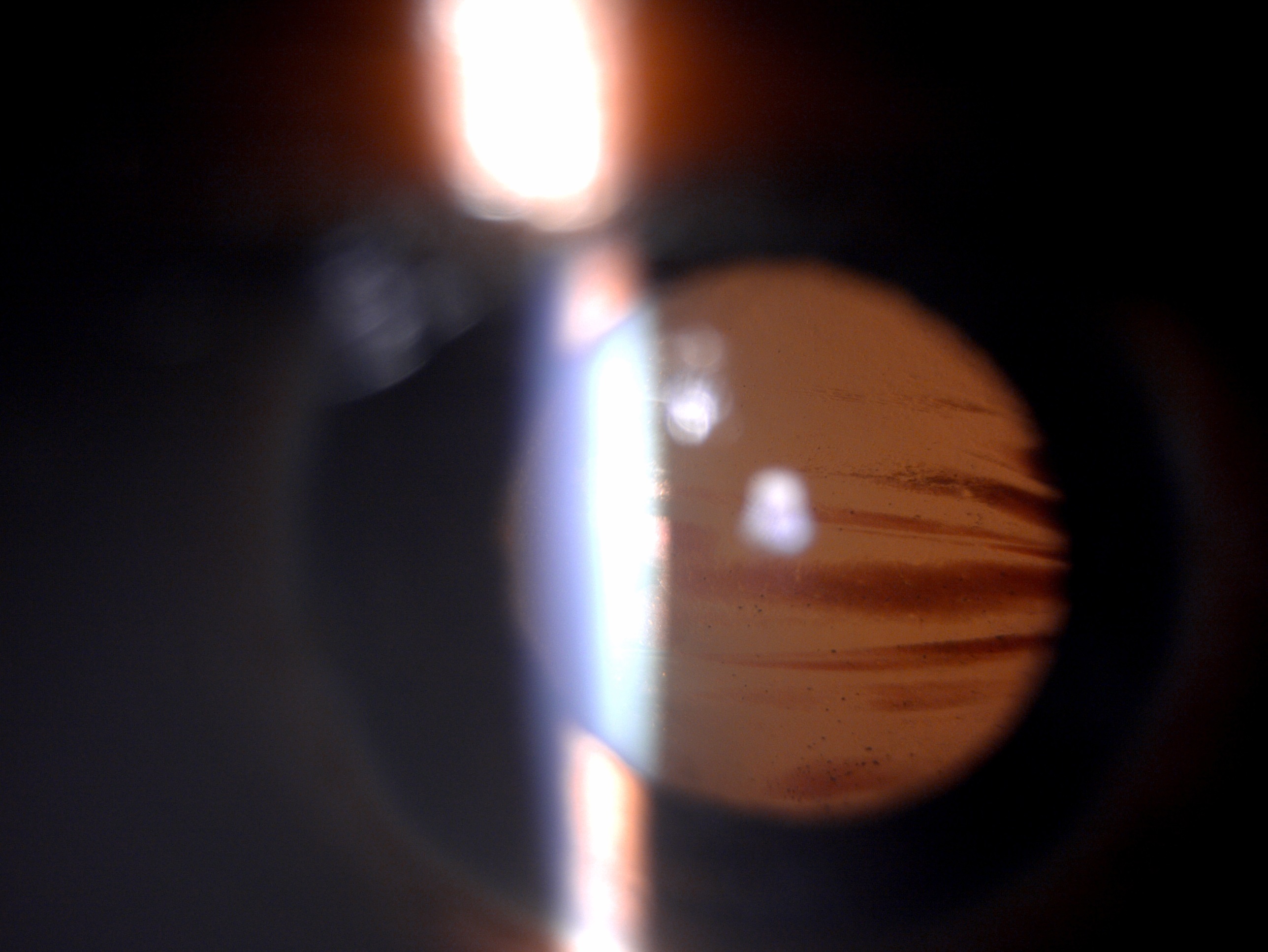 <p>Closed Globe Injury Lens Stain