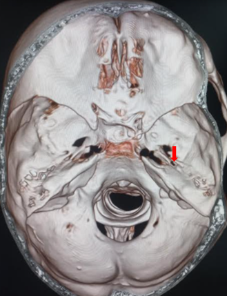 <p>Three-Dimensional Computed Tomography Reconstruction of the Middle Cranial Fossa and Foramen Spinosum