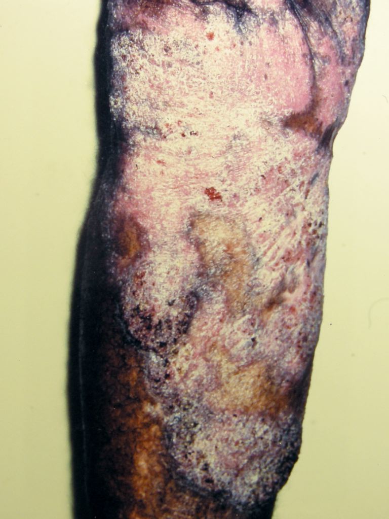 <p>Chromoblastomycosis.</p>