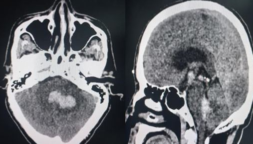 <p>Noncontrast CT of Cerebellar Hematoma