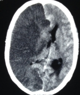 <p>Hemispheric Infarction Radiologic Findings. Image demonstrating gross midline shift in hemispheric infarction.</p>