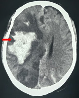 <p>Hemorrhagic Transformation Radiologic Finding