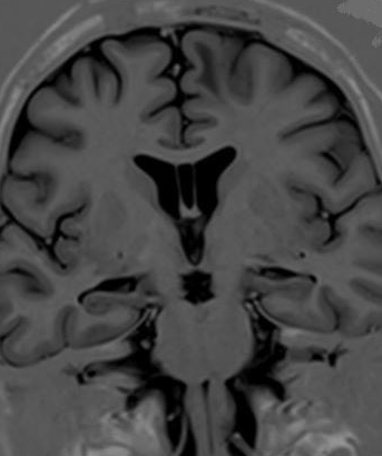 <p>Cavum Septi Pellucidi