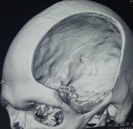 <p>Decompressive Hemicraniectomy. Image showing decompressive hemicraniectomy.</p>