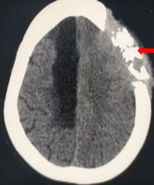 <p>Osteomyelitis. Computed tomography demonstrating osteomyelitis.</p>