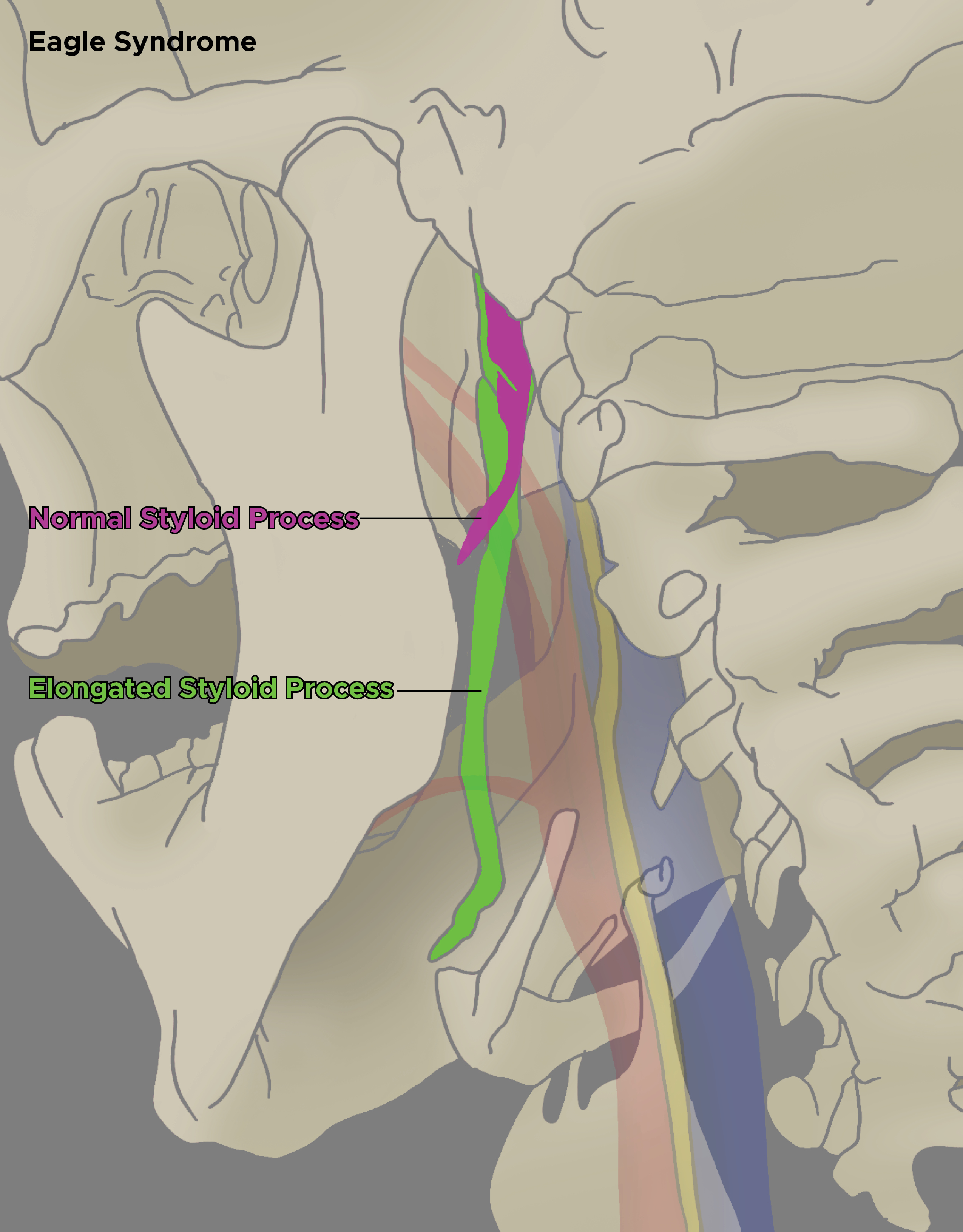 <p>Eagle Syndrome