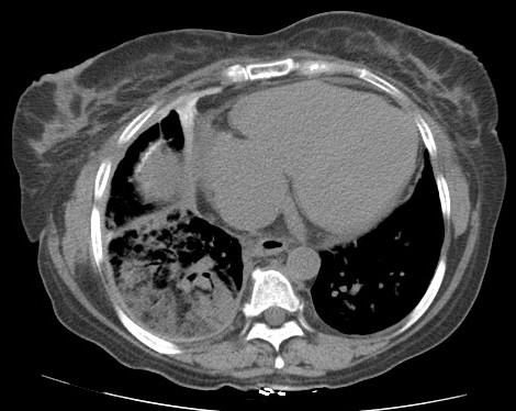 <p>Lipoid Pneumonia on Chest Computed Tomography