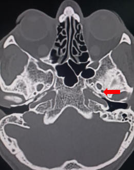<p>Radiographic Identification of the Foramen Spinosum