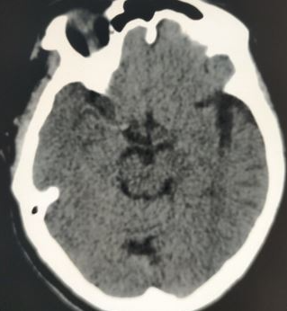 <p>Cord Sign. Imaging demonstrating cord sign indicative of acute infarction.</p>