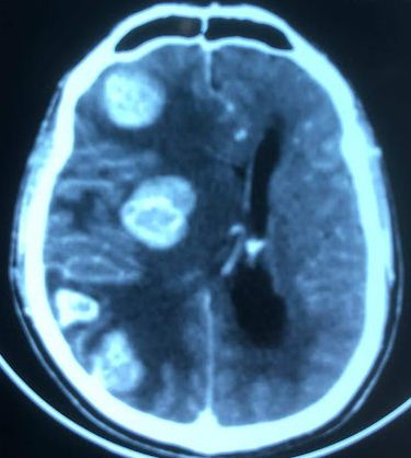 <p>Multiple Hemorrhagic Metastases to the Brain</p>