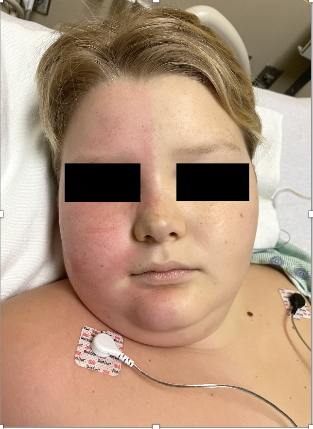 <p>Harlequin Syndrome
