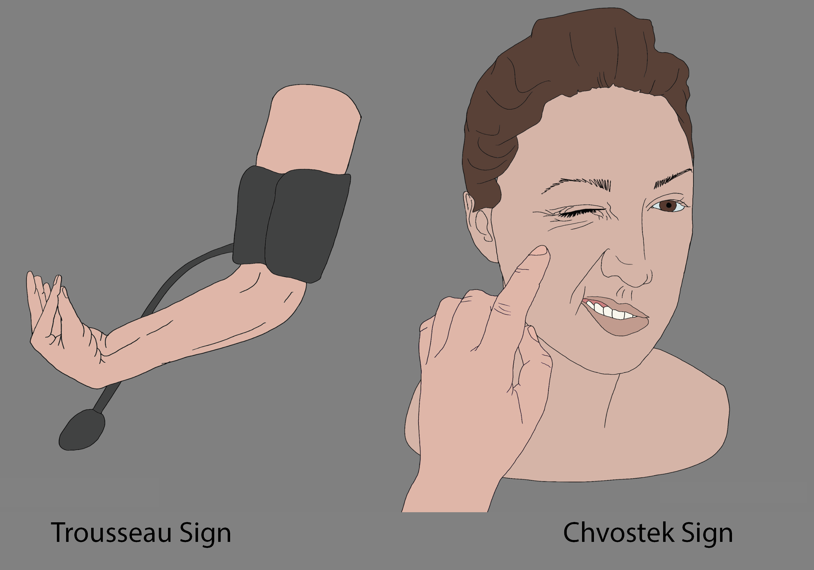 <p>Chvostek And Trousseau Signs
