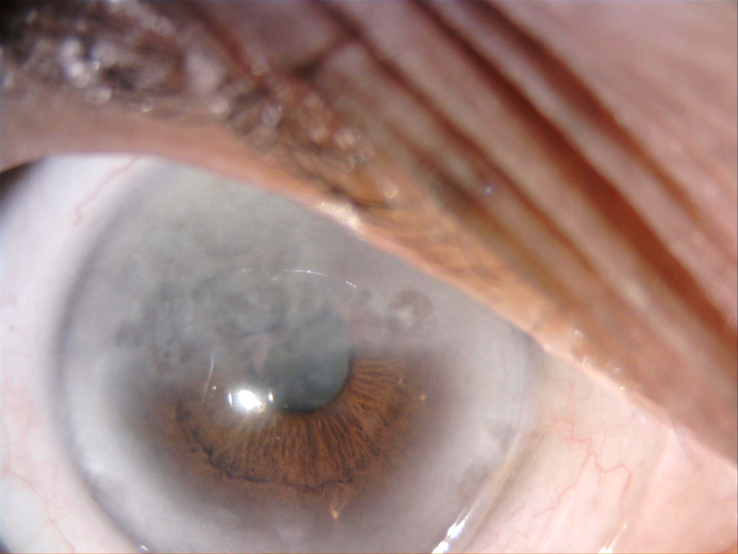 <p>Interstitial Keratitis, Slit Lamp