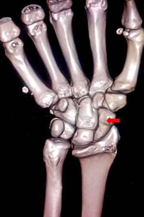 <p>Scaphoid Bone of the Wrist